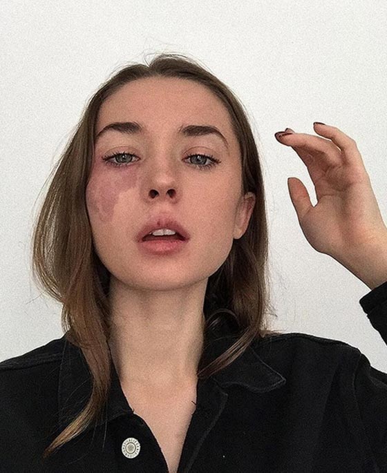 بالصور.. وحمة في وجه فتاة تثير ضجة عبر مواقع التواصل الإجتماعي صورة رقم 3