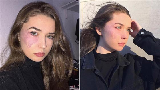 بالصور.. وحمة في وجه فتاة تثير ضجة عبر مواقع التواصل الإجتماعي صورة رقم 4