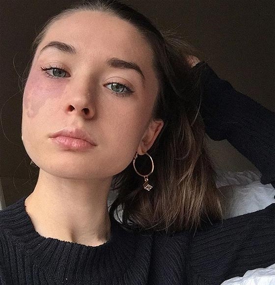 بالصور.. وحمة في وجه فتاة تثير ضجة عبر مواقع التواصل الإجتماعي صورة رقم 6