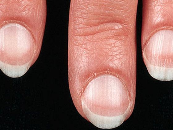 أعراض إذا شعرت بها فأنت مصاب بهذا المرض صورة رقم 2