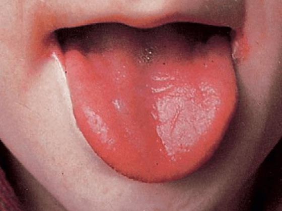 أعراض إذا شعرت بها فأنت مصاب بهذا المرض صورة رقم 9