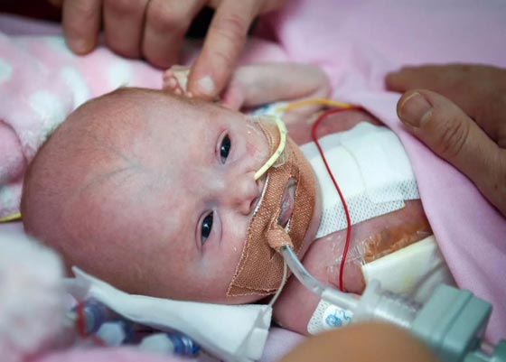 جراحة نادرة لرضيعة وُلدت بقلب خارج جسمها.. صور صورة رقم 5