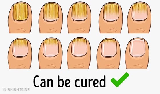 معلومات ومفاهيم خاطئة وما يقابلها من الحقيقة عن صحة الجسد صورة رقم 15