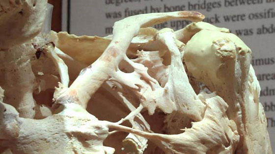 أغرب 9 حالات طبية حيّرت الاطباء! بكاء الصخور وطفلة لا تشعر بالألم صورة رقم 7