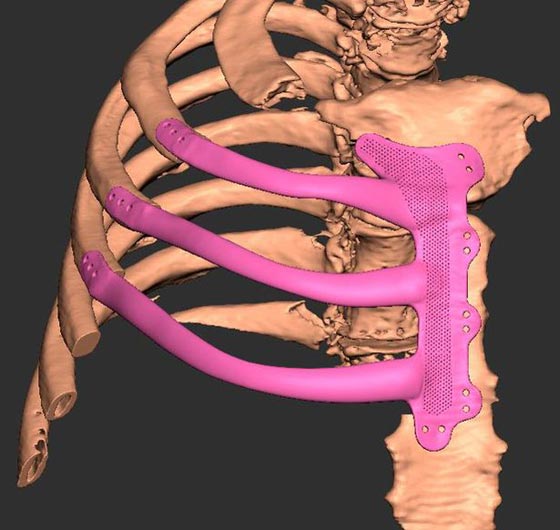 أول بريطاني يحصل على قفص صدري مطبوع بتقنية 3D! صورة رقم 6