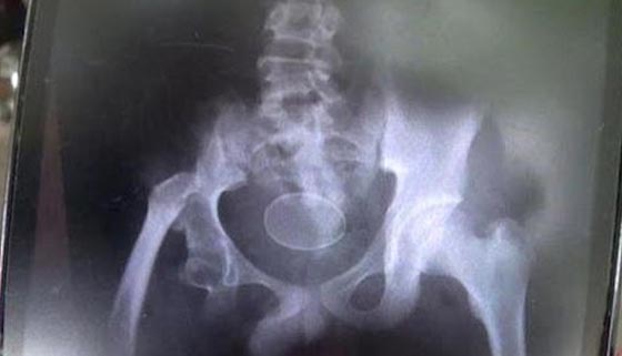 صدق او لا تصدق.. صبي يبيض كالدجاج  صورة رقم 3