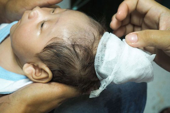 بالفيديو والصور.. حالة نادرة لولادة طفل مع قرن في رأسه  صورة رقم 3