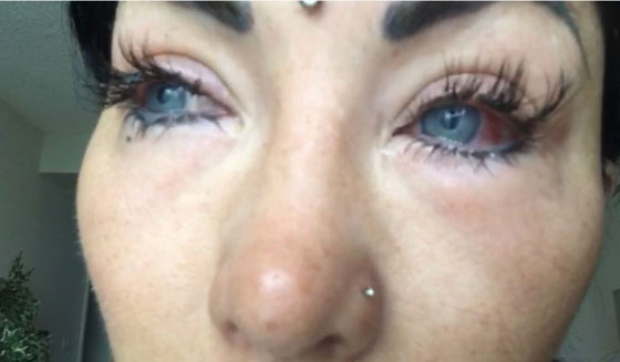 بالصور.. نجمة إنستغرام تصاب بالعمى بسبب تغيير لون عينيها صورة رقم 2