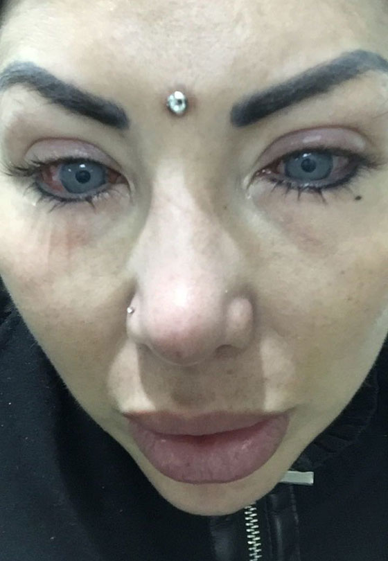 بالصور.. نجمة إنستغرام تصاب بالعمى بسبب تغيير لون عينيها صورة رقم 6