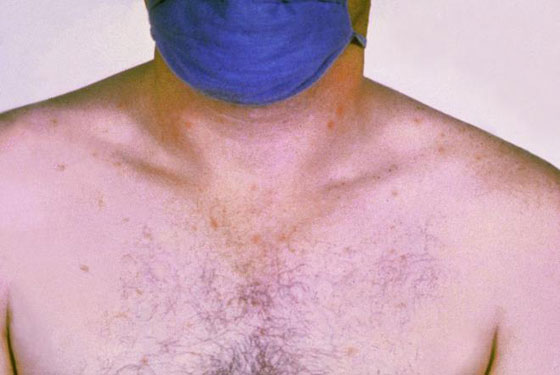 السكري، الصداع وانفصام الشخصية، 10 أمراض تكشف عن نفسها برائحتها صورة رقم 6