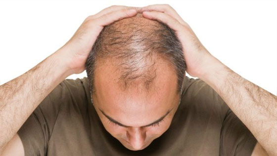 اكتشاف علاج مذهل يحارب الصلع ويوقف تساقط الشعر خلال أيام قليلة صورة رقم 3