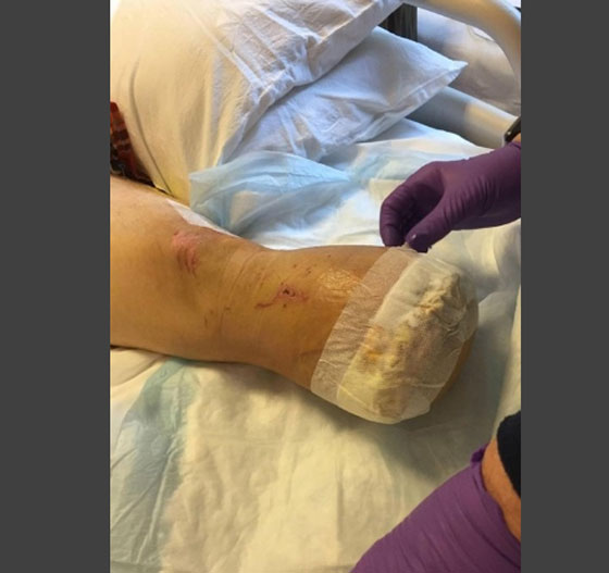 صور مقززة.. رجل يطهو قدمه المبتورة ويطعمها لاصدقائه! صورة رقم 5