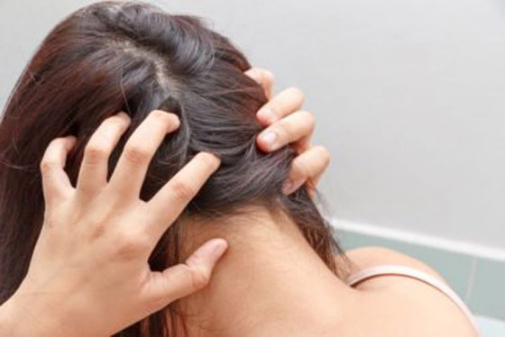بالفيديو.. كيف ولماذا نصاب بقمل الرأس وكيف يمكن التخلص منه؟ صورة رقم 2