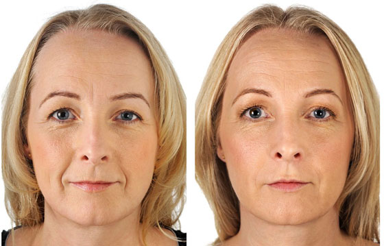 إليكم أغرب 10 عمليات تجميل في العالم صورة رقم 8
