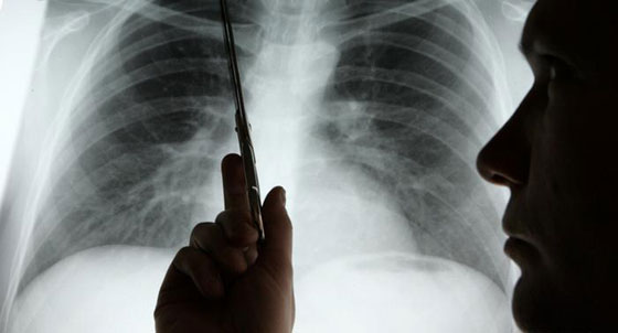 أكثر وأخطر مسببات للموت في العالم صورة رقم 7