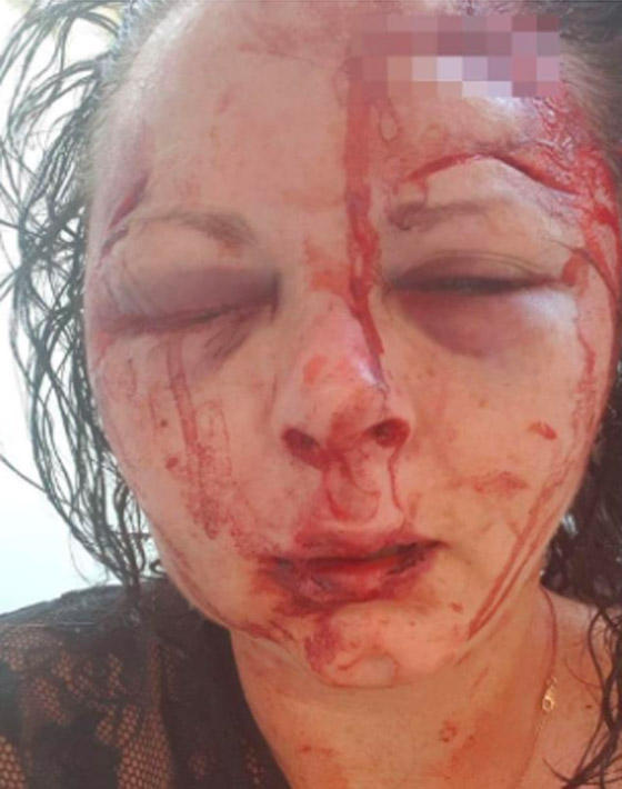 صور مروعة.. إعتداء وحشي على سائحة بريطانية في تركيا صورة رقم 2 صور مروعة.. إعتداء وحشي على سائحة بريطانية في تركيا صورة رقم 2