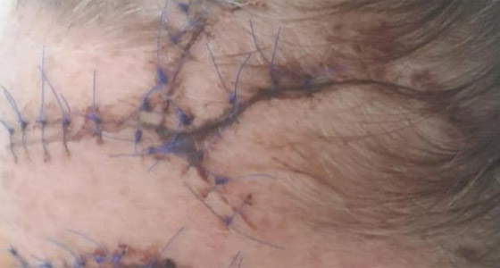 صور مروعة.. إعتداء وحشي على سائحة بريطانية في تركيا صورة رقم 4 صور مروعة.. إعتداء وحشي على سائحة بريطانية في تركيا صورة رقم 4