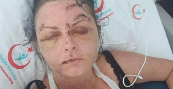 صور مروعة.. إعتداء وحشي على سائحة بريطانية في تركيا صورة رقم 3 صور مروعة.. إعتداء وحشي على سائحة بريطانية في تركيا صورة رقم 3