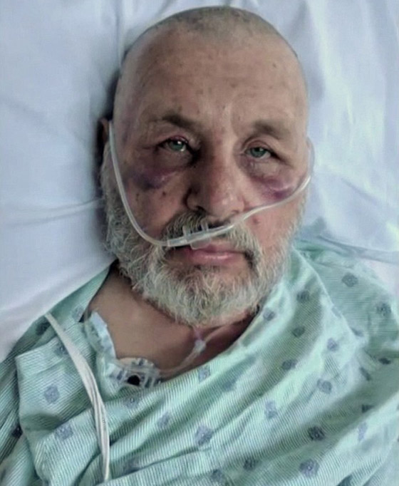 رجل أمريكي ينجو من الموت بأعجوبة بعد تعرضه لأكثر من 600 لدغة من النحل القاتل صورة رقم 1
