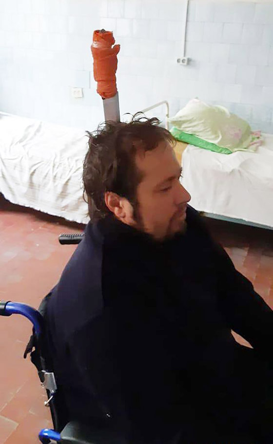فيديو مروع.. رجل روسي غرس سكينا في رأسه لمساعدته على التنفس! صورة رقم 9 فيديو مروع.. رجل روسي غرس سكينا في رأسه لمساعدته على التنفس! صورة رقم 9