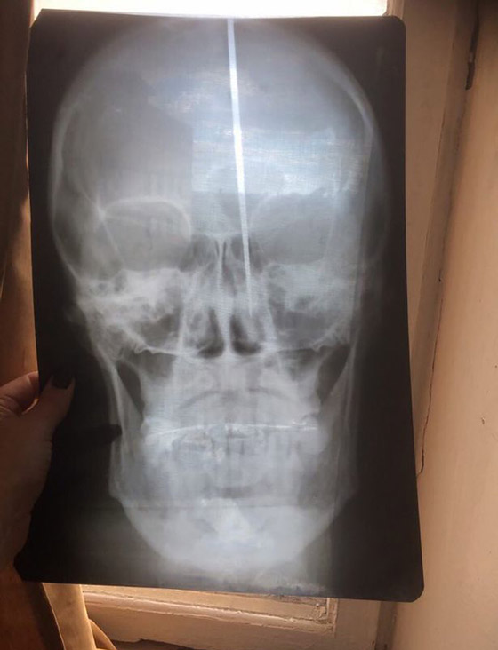 فيديو مروع.. رجل روسي غرس سكينا في رأسه لمساعدته على التنفس! صورة رقم 11 فيديو مروع.. رجل روسي غرس سكينا في رأسه لمساعدته على التنفس! صورة رقم 11