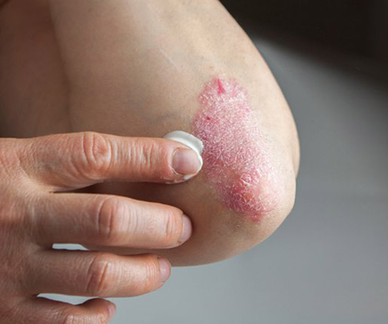 علاجات جديدة (بديلة) للمصابين بالصدفية تحمل آمالا كبيرة صورة رقم 4
