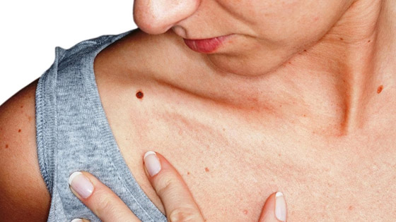 أهم الأعراض والعلامات التي تميز كل نوع من أنواع السرطان صورة رقم 4