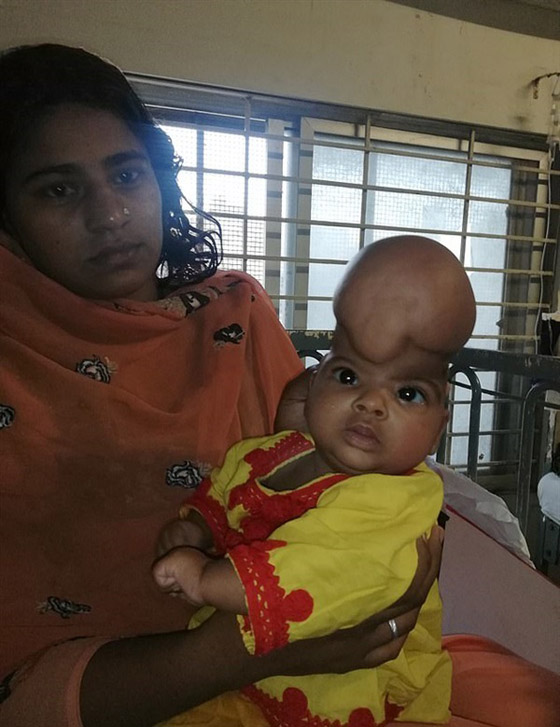 حالة نادرة: مخ طفلة باكستانية خارج جمجمتها صورة رقم 1