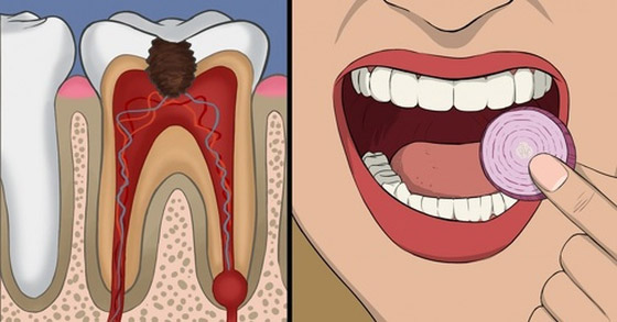 مجموعة علاجات بيتية مدهشة تساعد على توقف ألم ضرس العقل صورة رقم 11