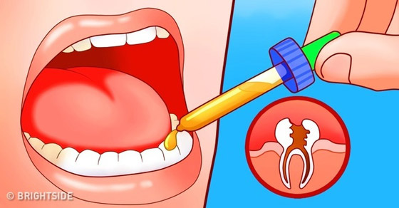 مجموعة علاجات بيتية مدهشة تساعد على توقف ألم ضرس العقل صورة رقم 7