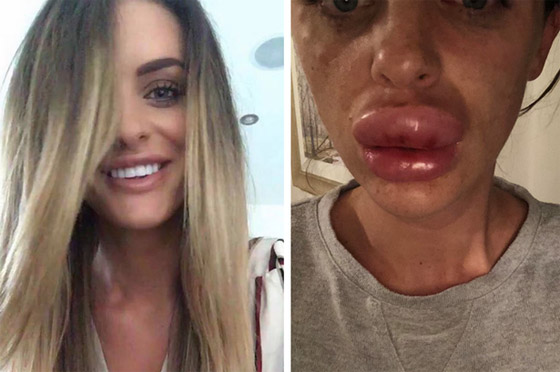 صور صادمة: البوتوكس يحول سيدة بريطانية جميلة الى مسخ صورة رقم 1