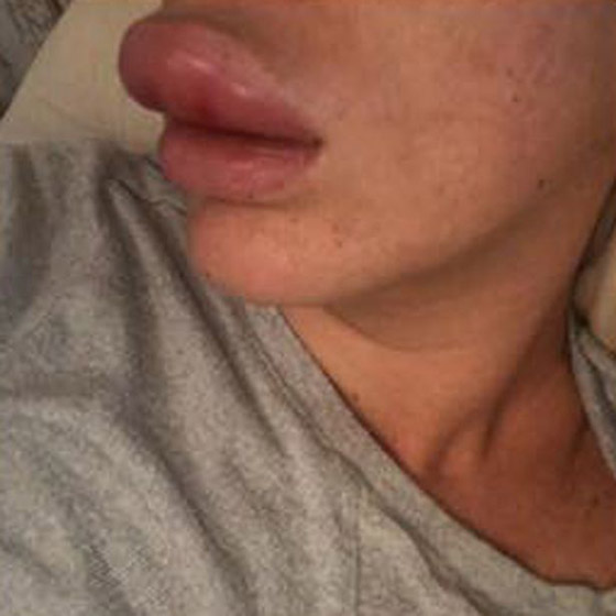 صور صادمة: البوتوكس يحول سيدة بريطانية جميلة الى مسخ صورة رقم 5