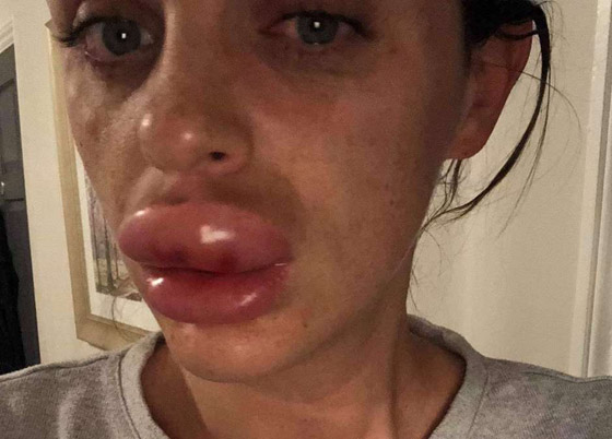 صور صادمة: البوتوكس يحول سيدة بريطانية جميلة الى مسخ صورة رقم 6