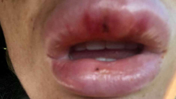 صور صادمة: البوتوكس يحول سيدة بريطانية جميلة الى مسخ صورة رقم 7