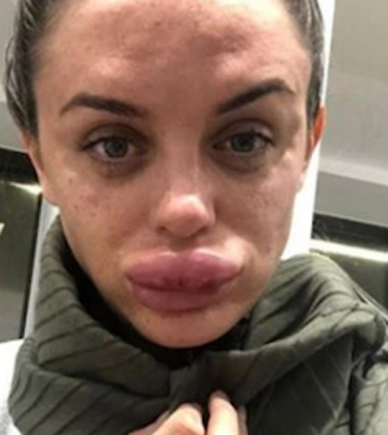 صور صادمة: البوتوكس يحول سيدة بريطانية جميلة الى مسخ صورة رقم 2