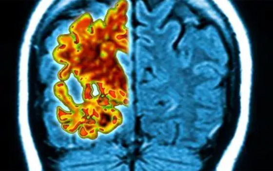  دراسة صادمة تؤكد: الزهايمر يمكن أن ينتقل كعدوى إلى الإنسان! صورة رقم 1