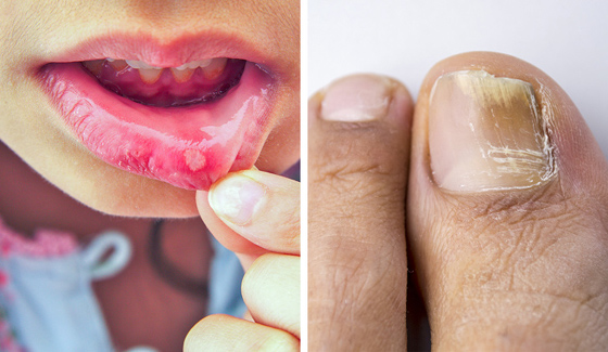 8 أعراض جانبية للمضادات الحيوية قد لا تعرفونها.. صورة رقم 1