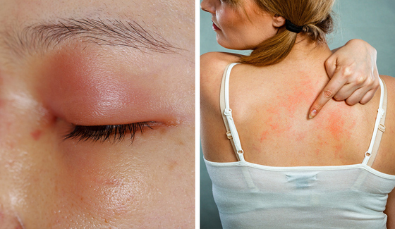 8 أعراض جانبية للمضادات الحيوية قد لا تعرفونها.. صورة رقم 4