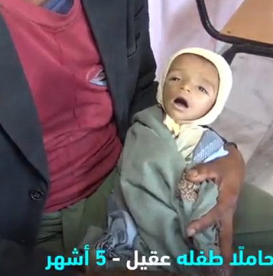  الطفل اليمني عقيل يموت جوعا أمام عيني والده! أين الضمير الانساني؟ صورة رقم 2