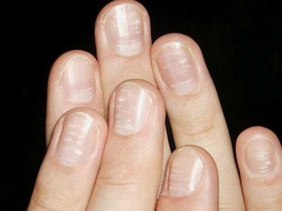 أبرز 8 مشكلات تظهر على الأظافر.. لا تتجاهلوها أبدا صورة رقم 3