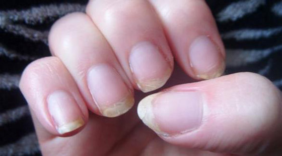 أبرز 8 مشكلات تظهر على الأظافر.. لا تتجاهلوها أبدا صورة رقم 1