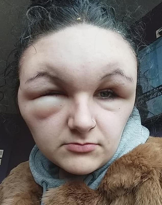 صبغة شعر تتسبب بتضخم وجه مراهقة وتصيبها بالعمى لمدة يومين! صور صورة رقم 1 صبغة شعر تتسبب بتضخم وجه مراهقة وتصيبها بالعمى لمدة يومين! صور صورة رقم 1
