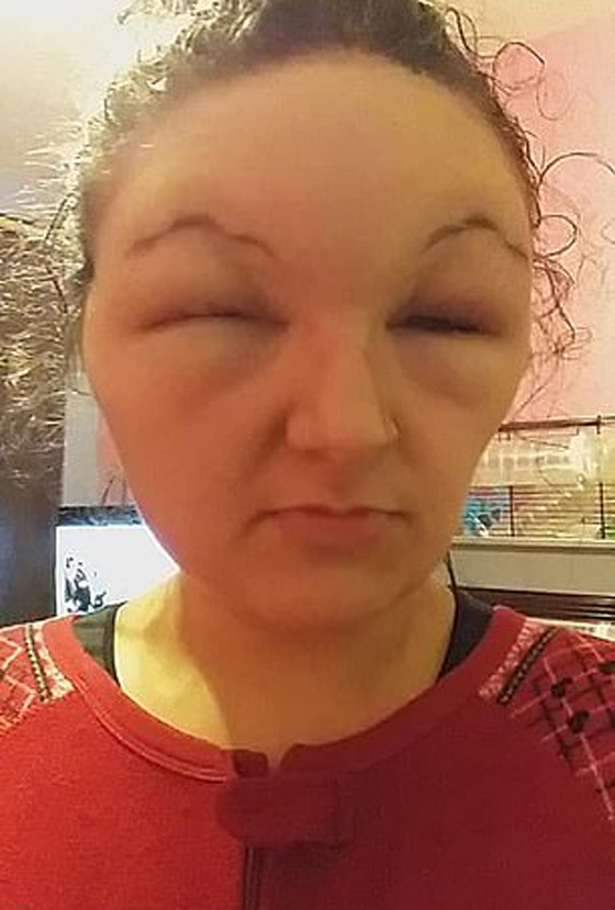 صبغة شعر تتسبب بتضخم وجه مراهقة وتصيبها بالعمى لمدة يومين! صور صورة رقم 2 صبغة شعر تتسبب بتضخم وجه مراهقة وتصيبها بالعمى لمدة يومين! صور صورة رقم 2