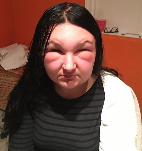 صبغة شعر تتسبب بتضخم وجه مراهقة وتصيبها بالعمى لمدة يومين! صور صورة رقم 4 صبغة شعر تتسبب بتضخم وجه مراهقة وتصيبها بالعمى لمدة يومين! صور صورة رقم 4