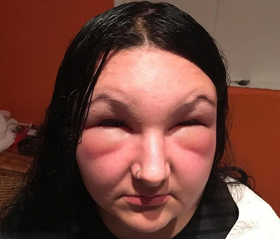 صبغة شعر تتسبب بتضخم وجه مراهقة وتصيبها بالعمى لمدة يومين! صور صورة رقم 5 صبغة شعر تتسبب بتضخم وجه مراهقة وتصيبها بالعمى لمدة يومين! صور صورة رقم 5