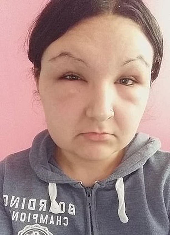 صبغة شعر تتسبب بتضخم وجه مراهقة وتصيبها بالعمى لمدة يومين! صور صورة رقم 6 صبغة شعر تتسبب بتضخم وجه مراهقة وتصيبها بالعمى لمدة يومين! صور صورة رقم 6