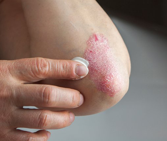 تعرفوا على أسباب الصدفية، أنواعها وأعراضها، طرق علاجها ومضاعفاتها صورة رقم 10 تعرفوا على أسباب الصدفية، أنواعها وأعراضها، طرق علاجها ومضاعفاتها صورة رقم 10