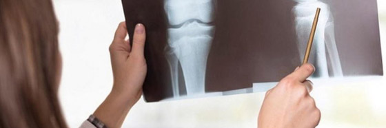 نصائح طبية.. هكذا تحمي عظامك مع تقدمك في العمر صورة رقم 5