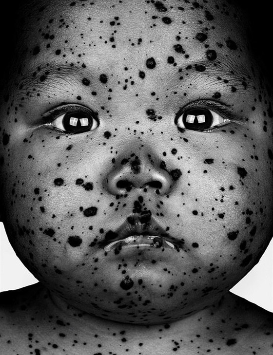 صور وحمات غريبة لأشخاص في جلسة تصوير لتقبل الذات صورة رقم 6