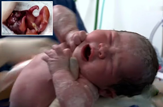 ظاهرة غريبة نادرة الحدوث: امرأة كولومبية تنجب طفلة حامل (بالصور) صورة رقم 7
